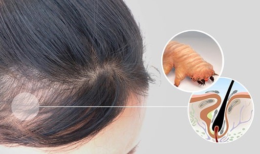 دمودکسها؛ انگلهای مضری که در سطح پوست شما هستند!