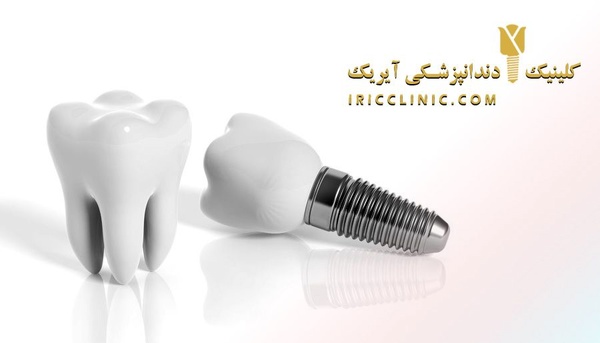 هزینه ایمپلنت دندان 1400 چقدره ؟ (آذر ماه سال 1400)