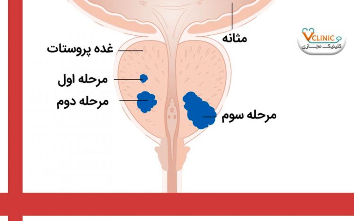 سرطان پروستات در مردان و مشکلات آن