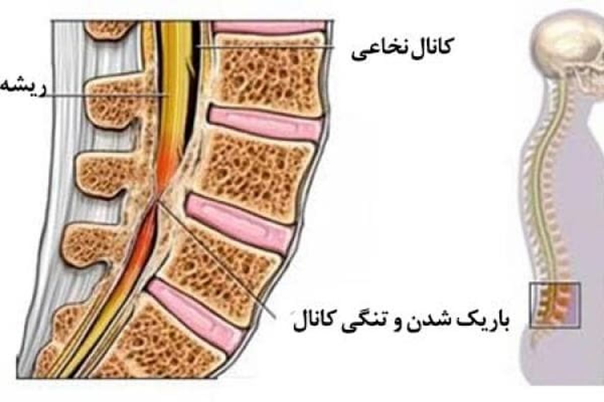 بهترین جراح تنگی کانال نخاع و ستون فقرات