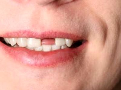 مشکلات جای خالی دندان و فاصله ایجاد شده بین دندان ها