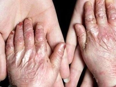 داروهای بیماران نادر به موقع تامین نمی‌شود/ عدم ترخیص دارو از گمرگ غیرقابل توجیه است

