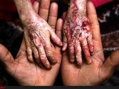 ۴ هزار و ۵۰۰ نفر درگیر بیماری ای بی/هزینه ماهیانه پماد و پانسمان؛ ۷۵۰ هزار تومان/وزارت بهداشت برای تهیه دارو همکاری کند