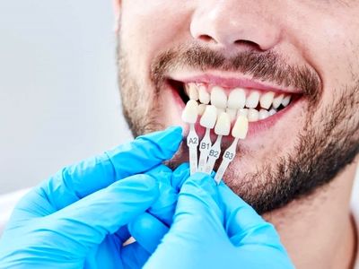 تفاوت لمینت و کامپوزیت دندان چیست؟
