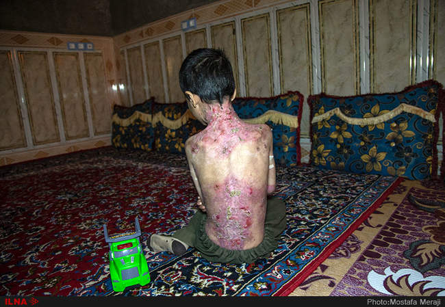 رنج کودکان پروانه ای جنوب کرمان در سایه بی توجهی مسئولین بهداشتی کشو