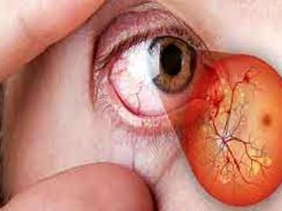 راه‌های جلوگیری از آسیب چشم ناشی از قند خون
