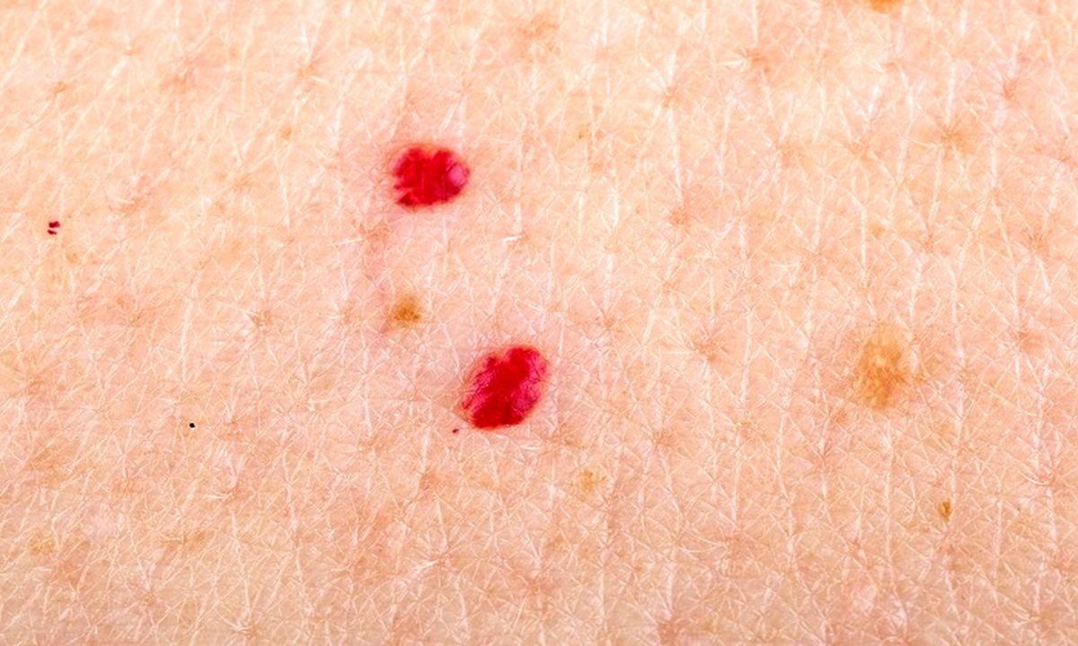 لکه‌های قرمز کوچک روی پوست و دلایل بروز آنها