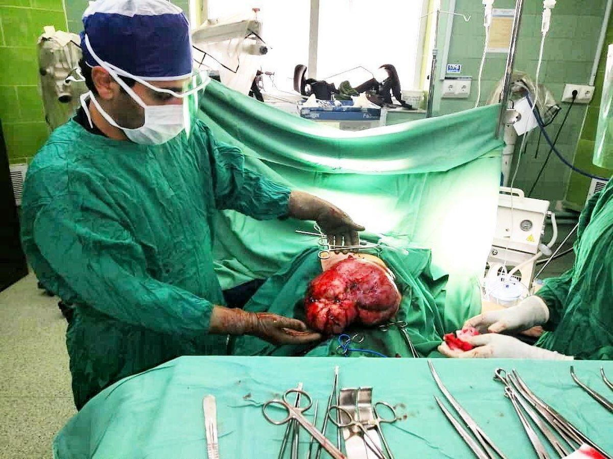 توده حجیمی از شکم بیمار ۶٠ ساله نیشابوری خارج شد