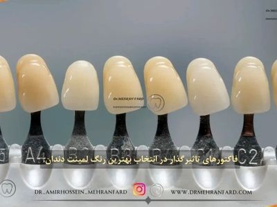 ۷ مورد از مواردی که قبل از انجام لمینت دندان باید بدانید! + [ فیلم مراحل ]