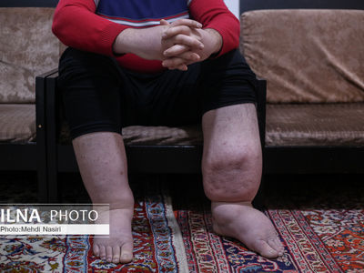 روایتی از سختی زندگی با "لنف ادم اولیه"/ هزینه‌ها بالاست؛ بی‌خیال درمان شدم+ عکس و فیلم