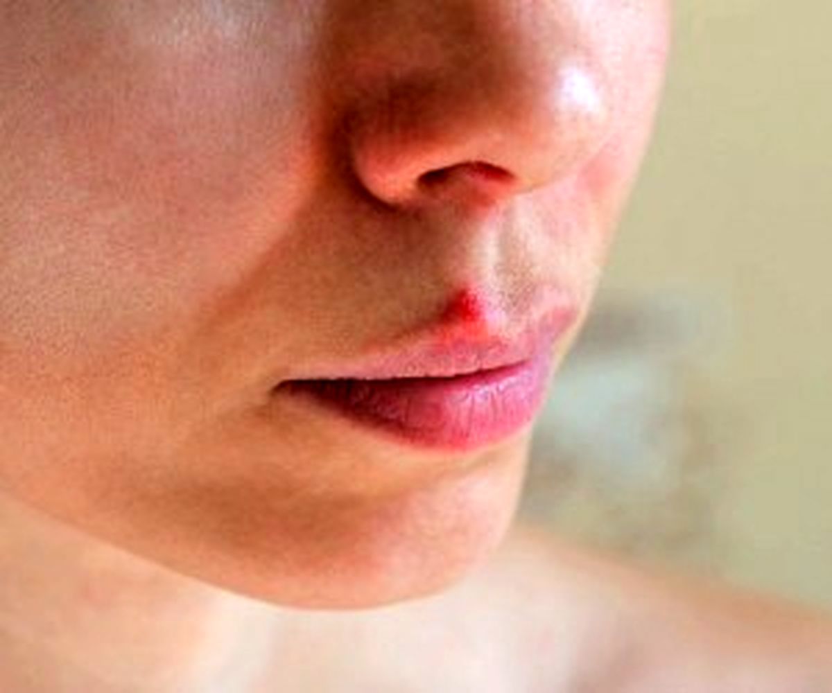 تبخال را سه دقیقه ای ناپدید کنید