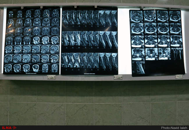 جراحی لامینکتومی توسط دکتر مهرداد اسماعیلی جراح مغز و اعصاب در بیمار