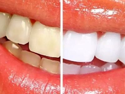 سفیدکردن دندانهای زرد به همین راحتی است